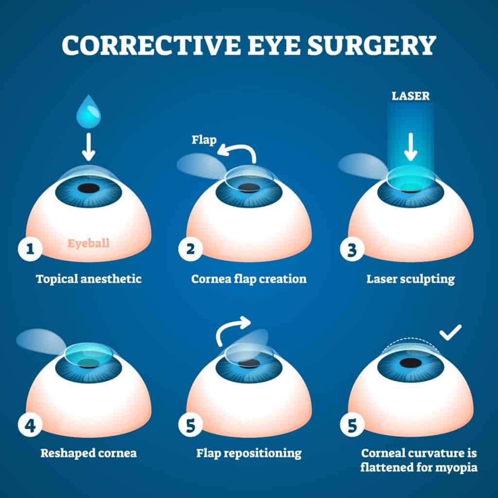 LASIK Infographic for Al Ain Patients